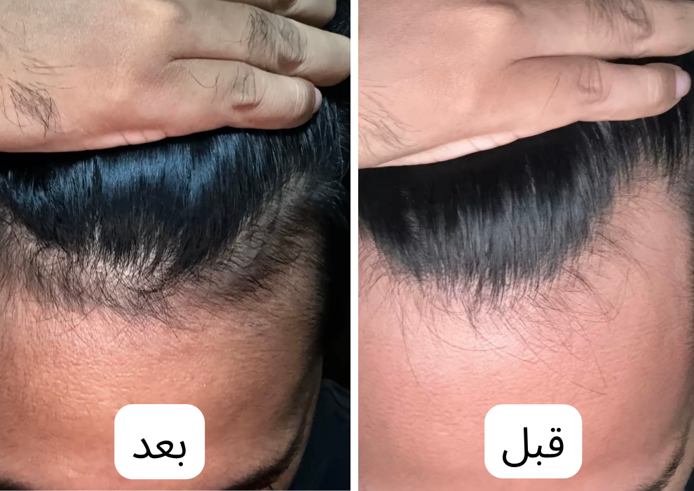 زيت سبيكتر™ | لمنطقة خط الشعر | كورس 4 شهور لافضل نتيجة