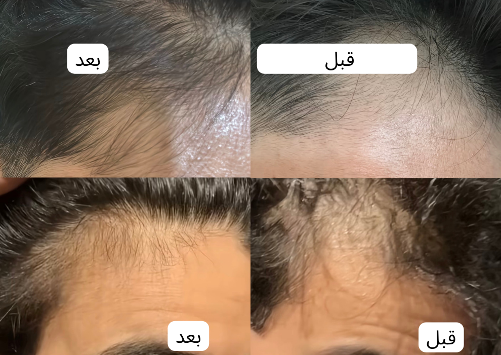 زيت سبيكتر™ | لمنطقة خط الشعر | كورس 4 شهور لافضل نتيجة