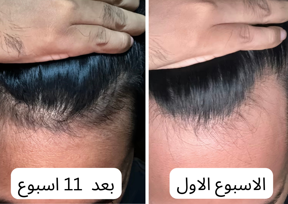 زيت سبيكتر™ | لمنطقة خط الشعر