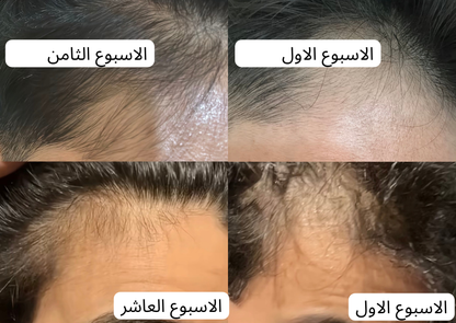 زيت سبيكتر™ | لمنطقة خط الشعر