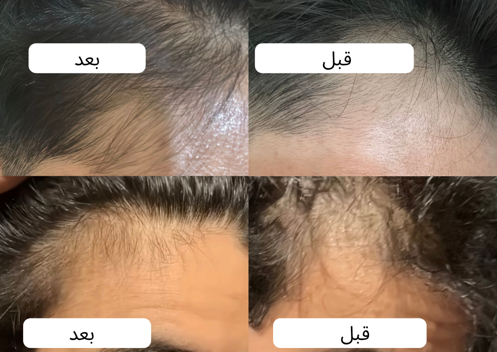 زيت سبيكتر™ | لمنطقة خط الشعر