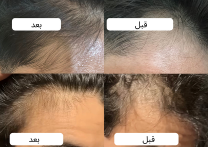 زيت سبيكتر™ | لمنطقة خط الشعر
