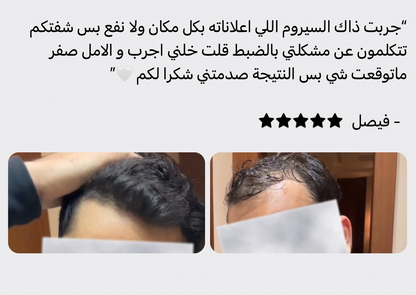 زيت سبيكتر™ | لمنطقة خط الشعر | كورس 4 شهور لافضل نتيجة