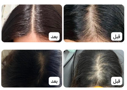 زيت سبيكتر™ | تركيبة مركزة لتساقط الشعر العنيد