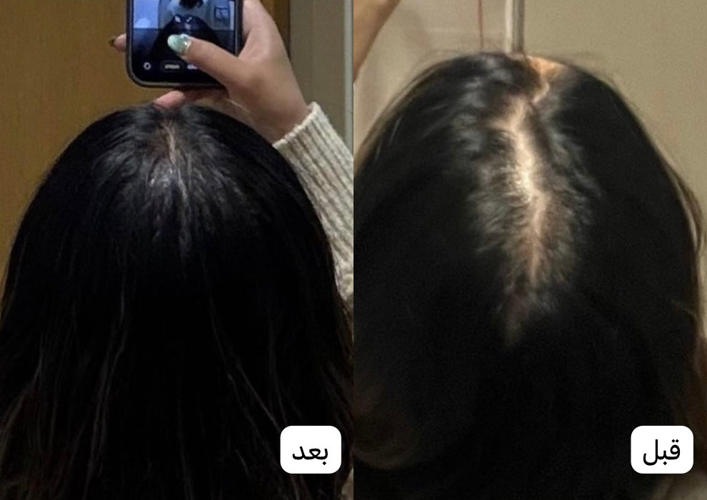 زيت سبيكتر™ | تركيبة مركزة لتساقط الشعر العنيد